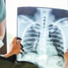 Ilustrasi rontgen paru-paru, ilustrasi TBC, ilustrasi x-ray, ilustrasi rontgen. WHO mengungkap, kematian akibat tuberkulosis meningkat selama pandemi. Foto: Dok. Istimewa