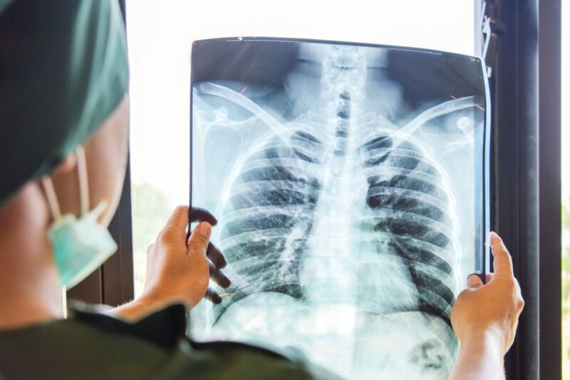 Ilustrasi rontgen paru-paru, ilustrasi TBC, ilustrasi x-ray, ilustrasi rontgen. WHO mengungkap, kematian akibat tuberkulosis meningkat selama pandemi. Foto: Dok. Istimewa 